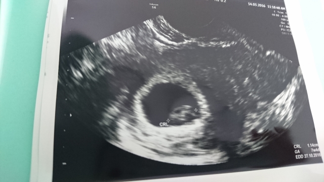 7週4天 · 第一次接觸胎兒的心跳